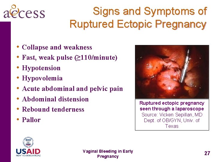 Signs and Symptoms of Ruptured Ectopic Pregnancy • Collapse and weakness • Fast, weak