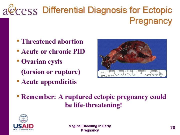 Differential Diagnosis for Ectopic Pregnancy • Threatened abortion • Acute or chronic PID •