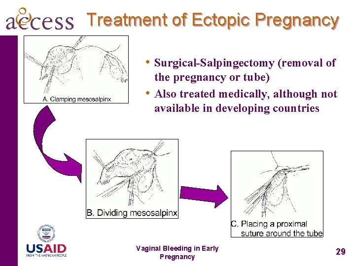 Treatment of Ectopic Pregnancy • Surgical-Salpingectomy (removal of • the pregnancy or tube) Also
