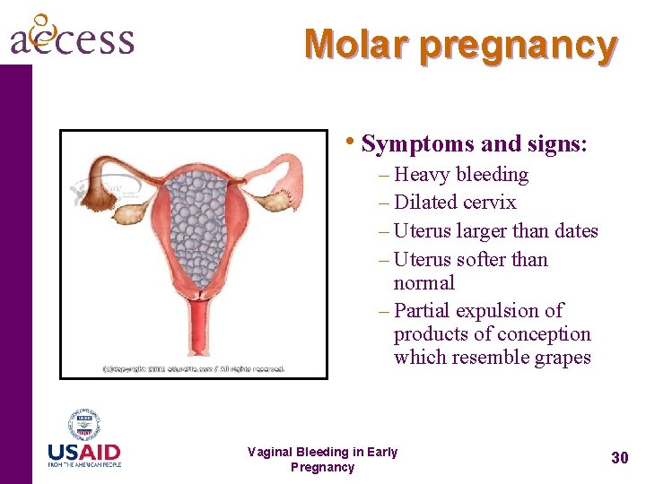 Molar pregnancy • Symptoms and signs: – Heavy bleeding – Dilated cervix – Uterus