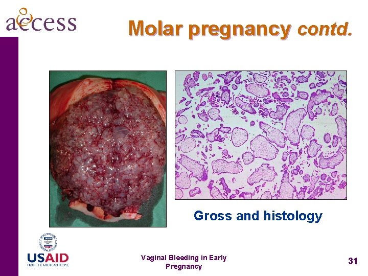 Molar pregnancy contd. Gross and histology Vaginal Bleeding in Early Pregnancy 31 
