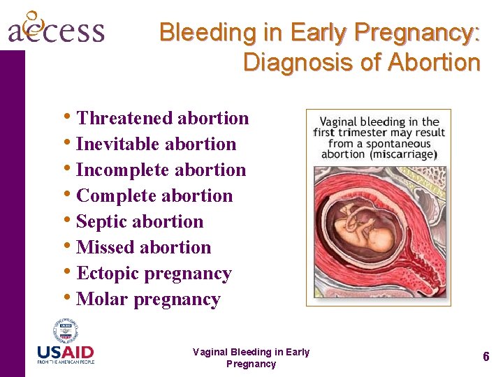 Bleeding in Early Pregnancy: Diagnosis of Abortion • Threatened abortion • Inevitable abortion •