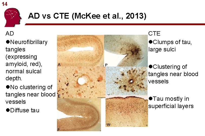 14 AD vs CTE (Mc. Kee et al. , 2013) AD l. Neurofibrillary tangles