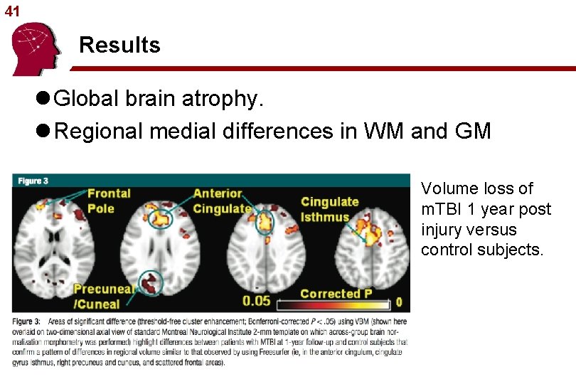 41 Results l Global brain atrophy. l Regional medial differences in WM and GM