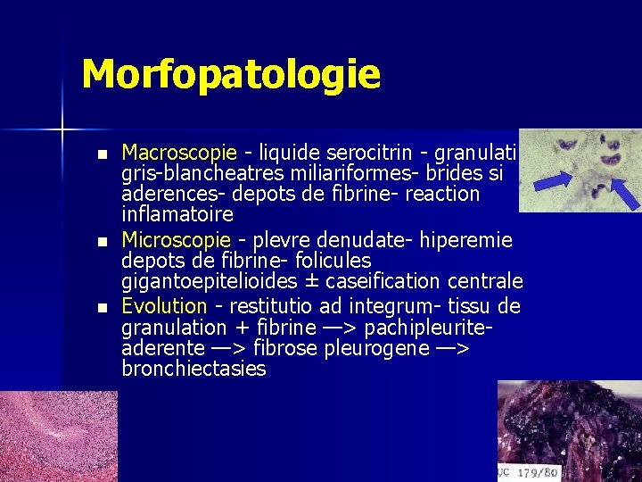 Morfopatologie n n n Macroscopie - liquide serocitrin - granulatii gris-blancheatres miliariformes- brides si