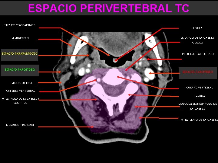 ESPACIO PERIVERTEBRAL TC LUZ DE OROFARINGE UVULA M. MESETERO M. LARGO DE LA CABEZACUELLO