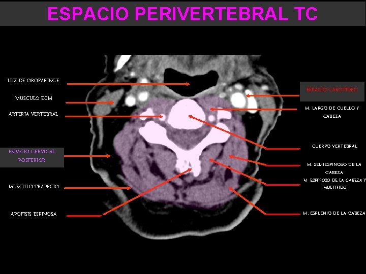 ESPACIO PERIVERTEBRAL TC LUZ DE OROFARINGE MUSCULO ECM ARTERIA VERTEBRAL ESPACIO CERVICAL POSTERIOR ESPACIO