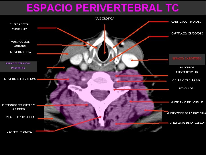 ESPACIO PERIVERTEBRAL TC LUZ GLÓTICA CUERDA VOCAL VERDADERA CARTILAGO TIROIDES CARTILAGO CRICOIDES VENA YUGULAR