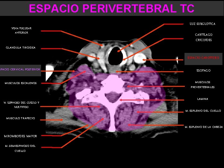 ESPACIO PERIVERTEBRAL TC LUZ SUBGLÓTICA VENA YUGULAR ANTERIOR CARTILAGO CRICOIDES GLANDULA TIROIDEA ESPACIO CAROTIDEO