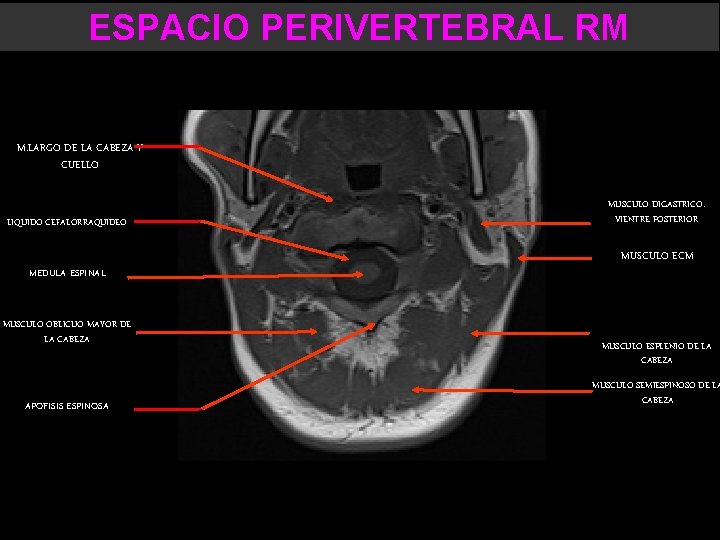 ESPACIO PERIVERTEBRAL RM M. LARGO DE LA CABEZA Y CUELLO LIQUIDO CEFALORRAQUIDEO MEDULA ESPINAL