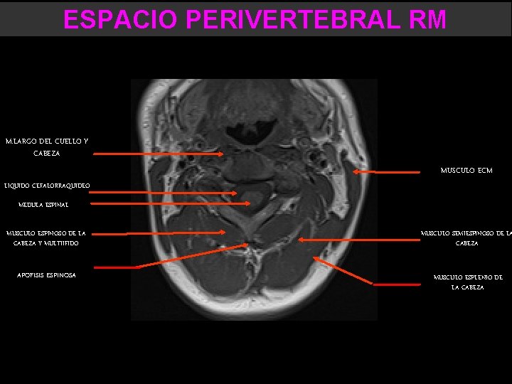 ESPACIO PERIVERTEBRAL RM M. LARGO DEL CUELLO Y CABEZA MUSCULO ECM LIQUIDO CEFALORRAQUIDEO MEDULA