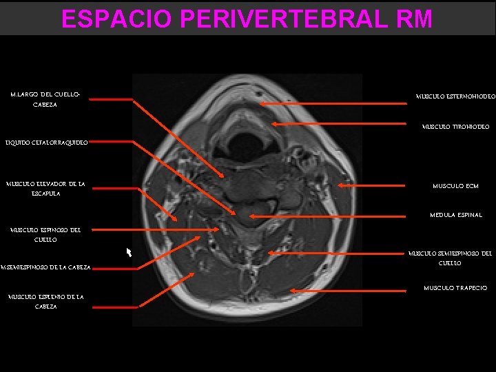 ESPACIO PERIVERTEBRAL RM M. LARGO DEL CUELLOCABEZA MUSCULO ESTERNOHIODEO MUSCULO TIROHIODEO LIQUIDO CEFALORRAQUIDEO MUSCULO