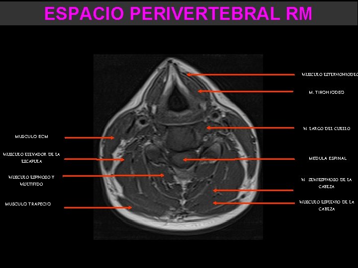 ESPACIO PERIVERTEBRAL RM MUSCULO ESTERNOHIODEO M. TIROHIODEO MUSCULO ECM M. LARGO DEL CUELLO MUSCULO