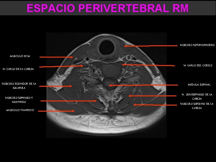 ESPACIO PERIVERTEBRAL RM MUSCULO ESTERNOHIODEO MUSCULO ECM M- LARGO DE LA CABEZA MUSCULO ELEVADOR