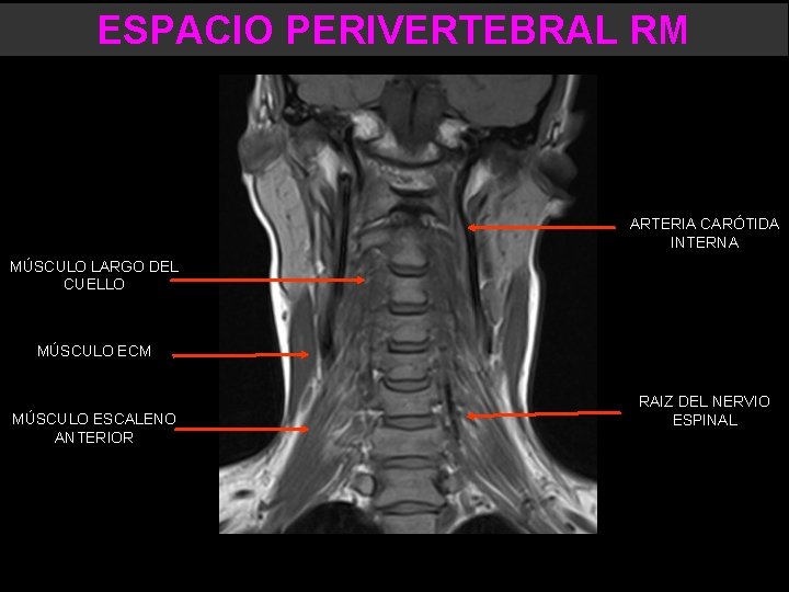 ESPACIO PERIVERTEBRAL RM ARTERIA CARÓTIDA INTERNA MÚSCULO LARGO DEL CUELLO MÚSCULO ECM MÚSCULO ESCALENO