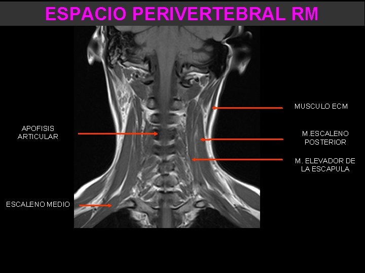 ESPACIO PERIVERTEBRAL RM MUSCULO ECM APOFISIS ARTICULAR M. ESCALENO POSTERIOR M. ELEVADOR DE LA