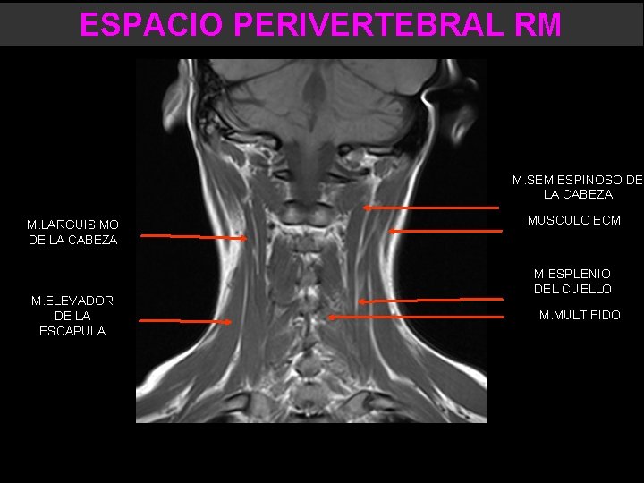 ESPACIO PERIVERTEBRAL RM M. SEMIESPINOSO DE LA CABEZA M. LARGUISIMO DE LA CABEZA M.