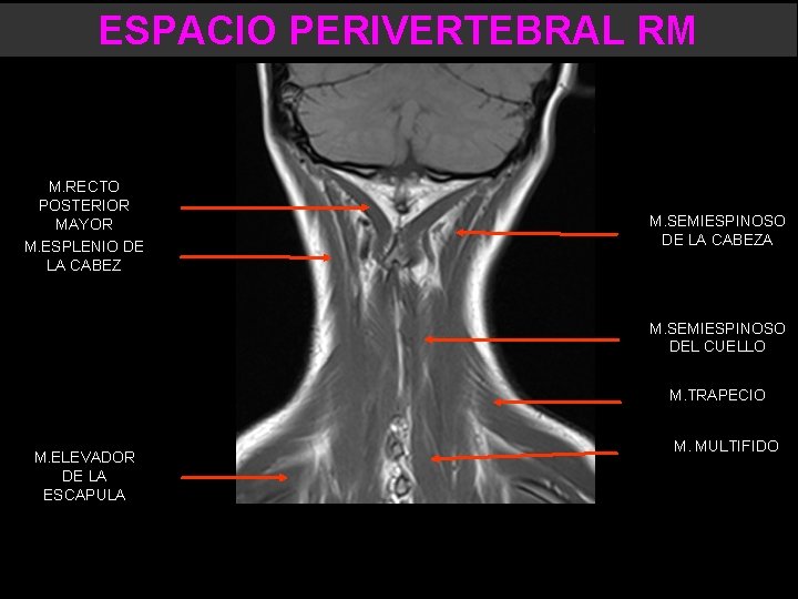 ESPACIO PERIVERTEBRAL RM M. ESPLENIO DE LA CABEZA M. RECTO POSTERIOR MAYOR M. ESPLENIO