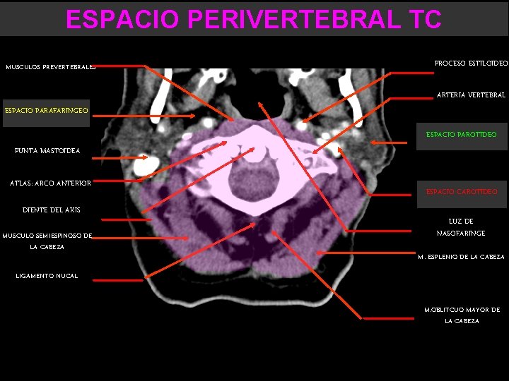 ESPACIO PERIVERTEBRAL TC MUSCULOS PREVERTEBRALES PROCESO ESTILOIDEO ARTERIA VERTEBRAL ESPACIO PARAFARINGEO ESPACIO PAROTIDEO PUNTA