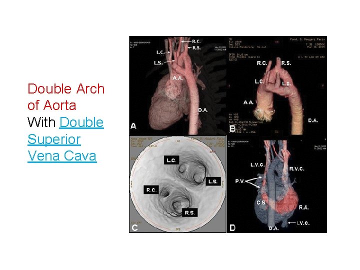 Double Arch of Aorta With Double Superior Vena Cava 