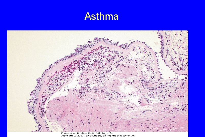 Asthma 111 