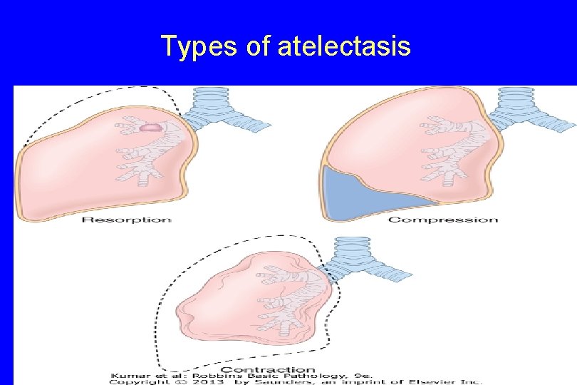 Types of atelectasis 12 