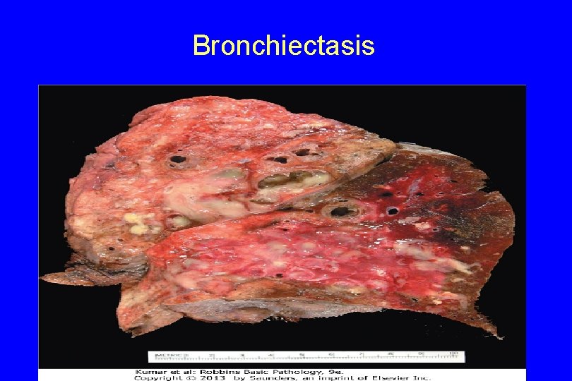 Bronchiectasis 123 