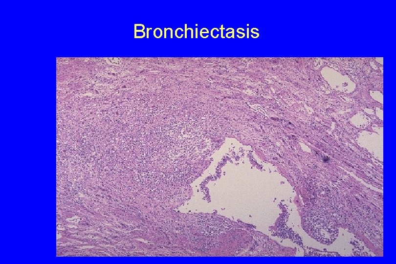 Bronchiectasis 127 