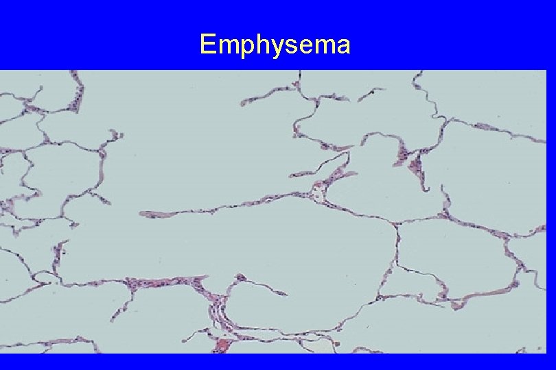 Emphysema 