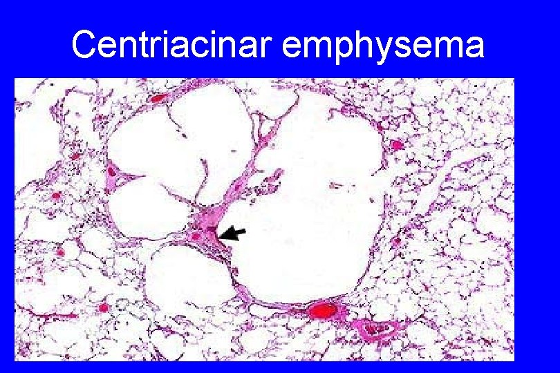 Centriacinar emphysema 52 