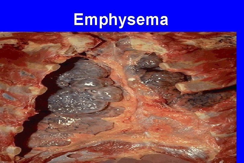 Emphysema 60 