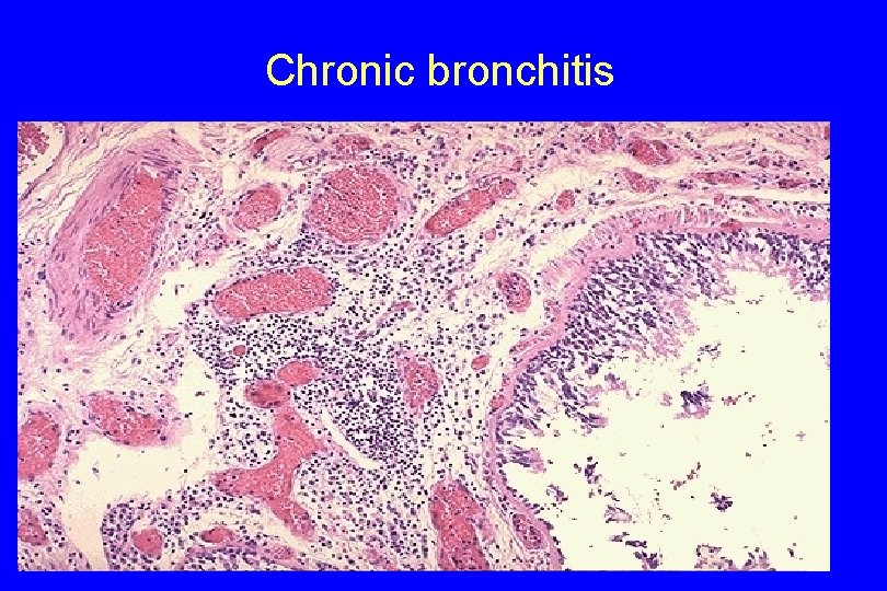 Chronic bronchitis 86 