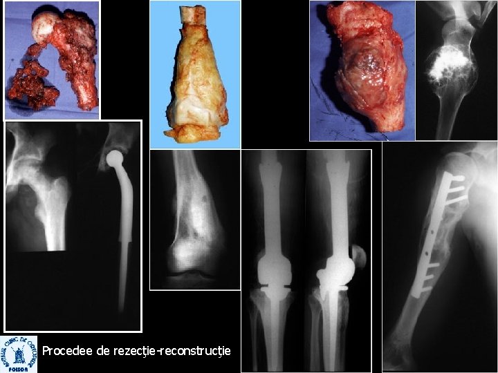 Procedee de rezecţie-reconstrucţie 