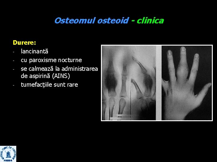 Osteomul osteoid - clinica Durere: - lancinantă - cu paroxisme nocturne - se calmează