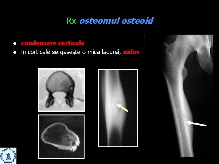 Rx osteomul osteoid l l condensare corticala in corticale se gaseşte o mica lacună,