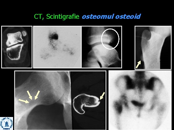 CT, Scintigrafie osteomul osteoid 