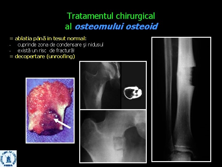 Tratamentul chirurgical al osteomului osteoid = ablatia până în tesut normal: cuprinde zona de
