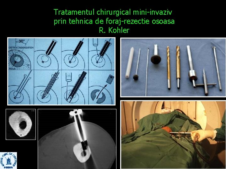 Tratamentul chirurgical mini-invaziv prin tehnica de foraj-rezectie osoasa R. Kohler 