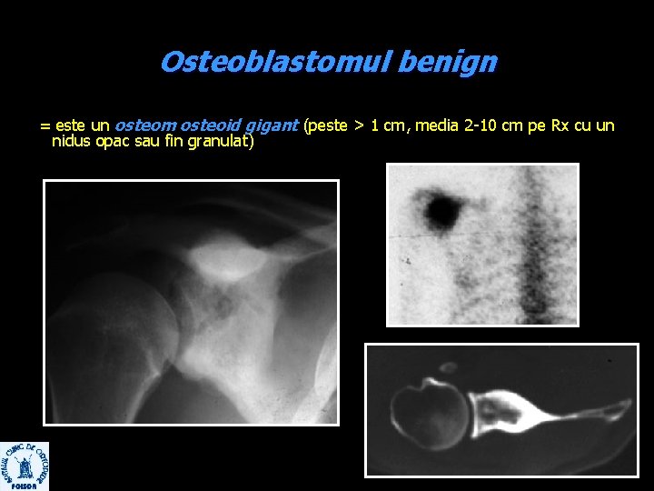 Osteoblastomul benign = este un osteom osteoid gigant (peste > 1 cm, media 2