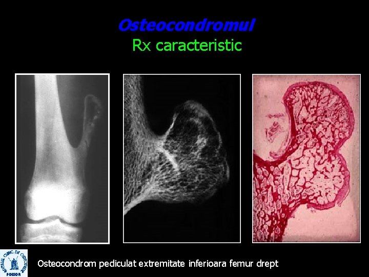 Osteocondromul Rx caracteristic Osteocondrom pediculat extremitate inferioara femur drept 