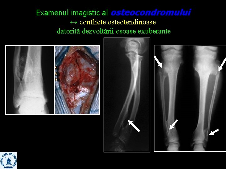 Examenul imagistic al osteocondromului ↔ conflicte osteotendinoase datorită dezvoltării osoase exuberante 