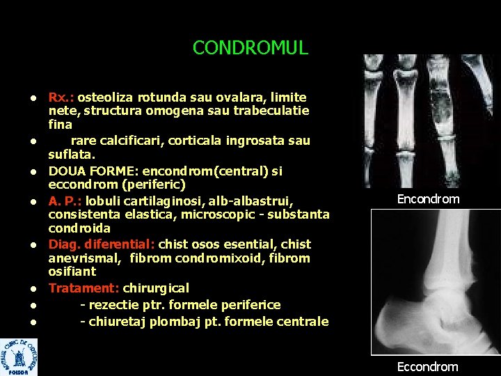 CONDROMUL l l l l Rx. : osteoliza rotunda sau ovalara, limite nete, structura