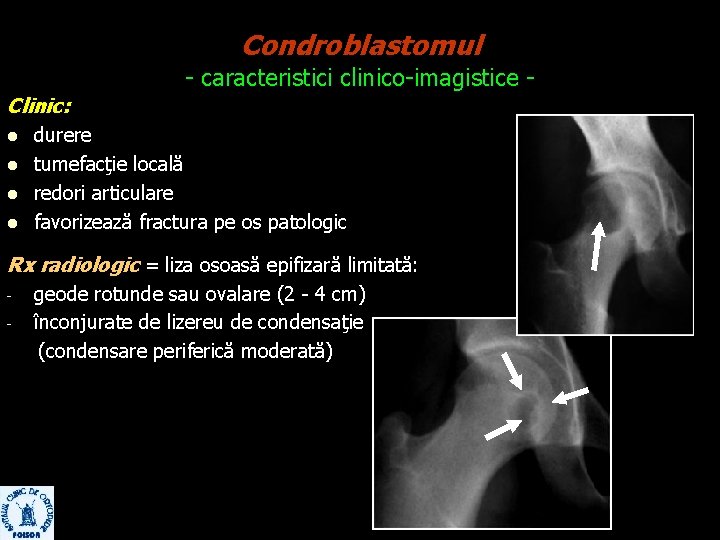 Condroblastomul - caracteristici clinico-imagistice Clinic: l l durere tumefacţie locală redori articulare favorizează fractura