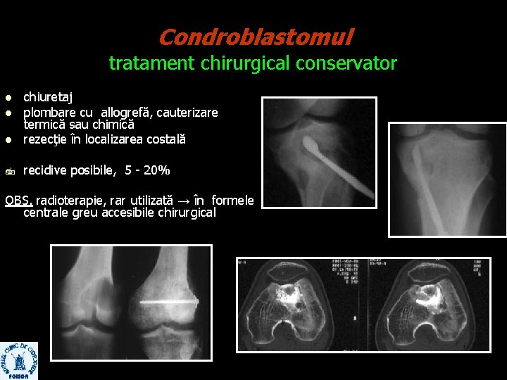 Condroblastomul tratament chirurgical conservator l chiuretaj plombare cu allogrefă, cauterizare termică sau chimică rezecţie