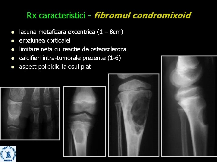 Rx caracteristici - fibromul condromixoid l l lacuna metafizara excentrica (1 – 8 cm)