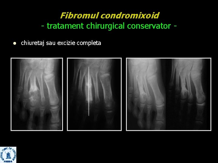 Fibromul condromixoid - tratament chirurgical conservator l chiuretaj sau excizie completa 