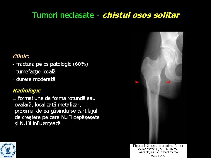 Tumori neclasate - chistul osos solitar Clinic: - fractura pe os patologic (60%) tumefacţie