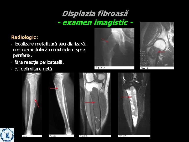 Displazia fibroasă - examen imagistic Radiologic: - localizare metafizară sau diafizară, centro-medulară cu extindere