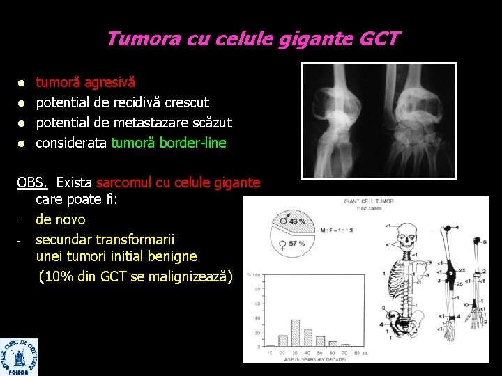 Tumora cu celule gigante GCT l l tumoră agresivă potential de recidivă crescut potential