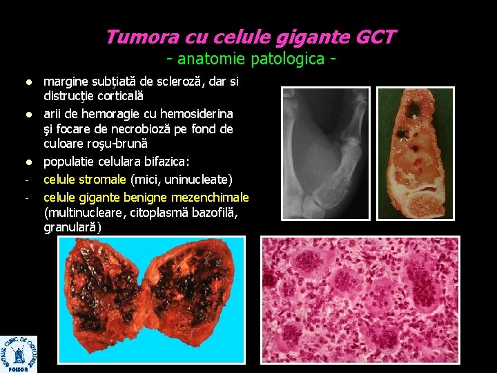 Tumora cu celule gigante GCT - anatomie patologica - l l l - margine